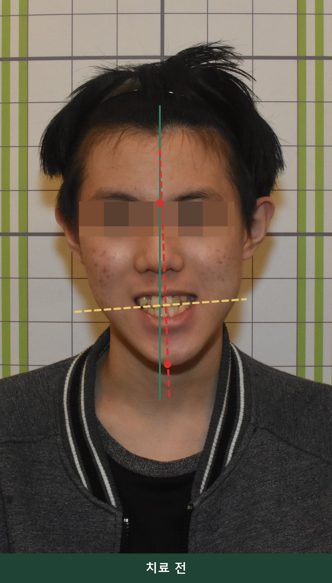 안면비대칭 턱관절교정 치료 전 정면 사진. 미간을 지나는 기준 중심선(초록 실선)과 턱끝까지의 실제 안면 축(빨간 점선)이 어긋나 있고 입꼬리 선이 기울어져 있음